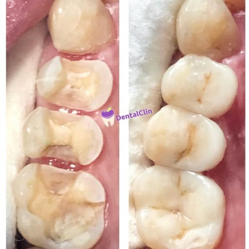 Incrustación-dental-en-CDMX-y-Puebla