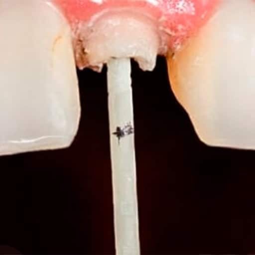 Colocación de Endoposte en CDMX y Puebla | DentalClin